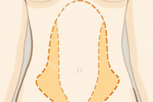 韩国口碑吸脂医院名单：集美实测365mc/Qline腰腹大腿环吸，术后不反弹不凹凸！