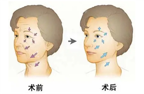 面部年轻化管理前后对比