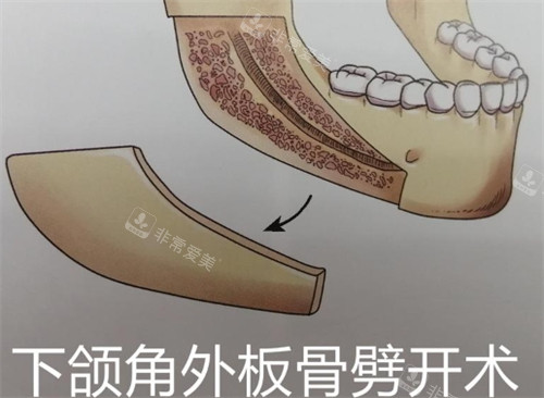 下颌角外板劈开术