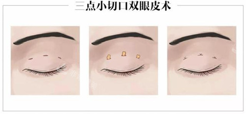 三点定位双眼皮的操作步骤