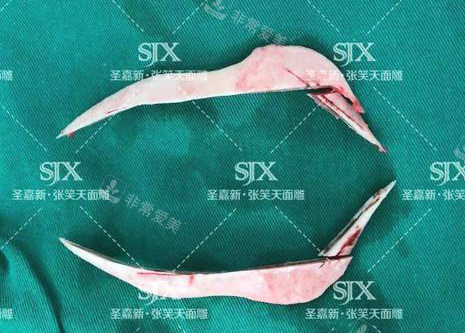 北京圣嘉新医疗美容医院张笑天下颌角手术截骨