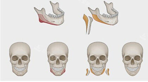 下颌骨外板整形卡通示意图