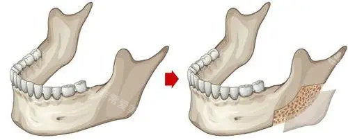 下颌骨外板位置示意图