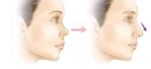 鼻翼缘后缩的症状