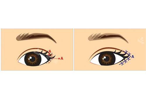 开外眼角前后对比图