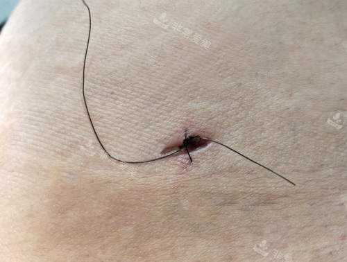 吸脂手术真是伤口