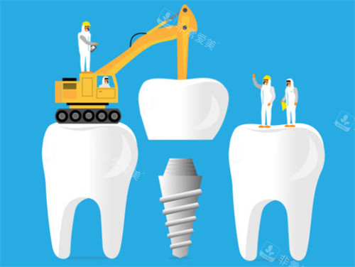 种植牙工程示意图