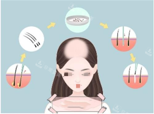 植发过程动画图