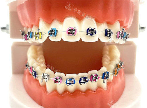 金属托槽矫正模型图片