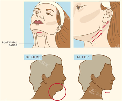 面部提升改善下颌 面部提升改善下颌