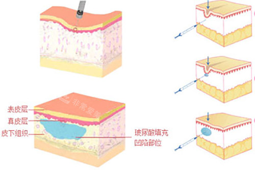 韩国面部玻尿酸填充体验感赞吗？面部填充更准一些塑形+前后对比超惊艳，韩国风格体验超舒心