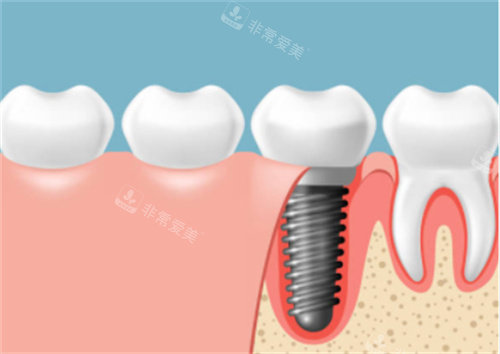 种植牙在口腔剖面图