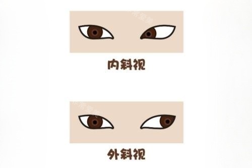 眼睛内斜视和外斜视卡通对比图