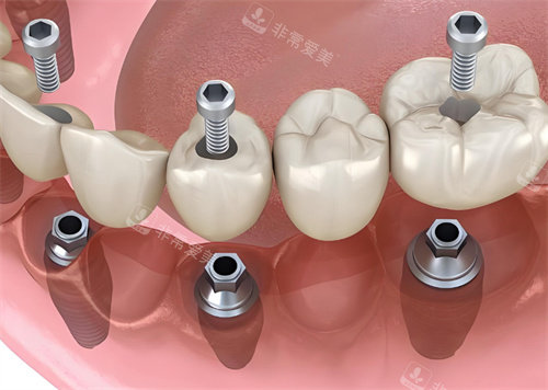 牙齿种植牙模型