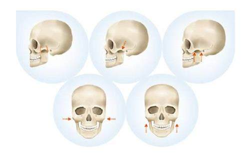 磨骨手术手术过程 磨骨手术手术过程