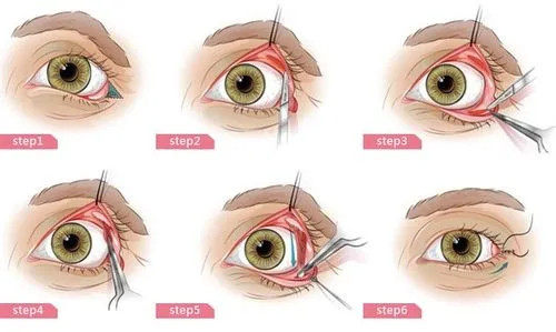 内切法眼整形卡通示意图 内切法眼整形卡通示意图