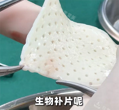 生物补片改善增大增粗照片