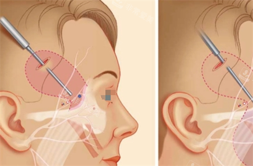 微拉美手术位置示意图 微拉美手术位置示意图