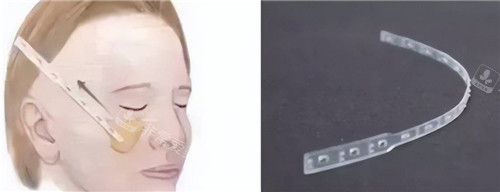 钟桂强医生微拉美提升口碑好吗？双倒齿结构+小创伤操作，PLGA材质+三层提拉，体验感受分享！