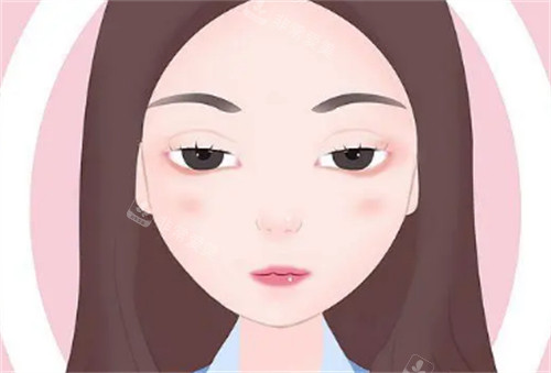 上眼睑下垂卡通图