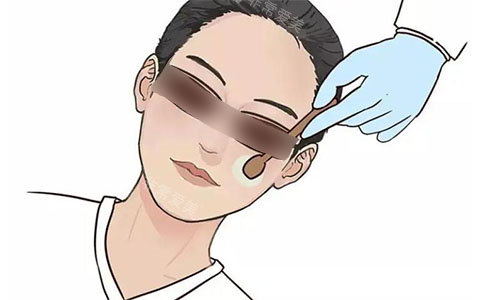 光子嫩肤示意图