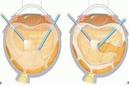 玻璃体切除术过程示意图