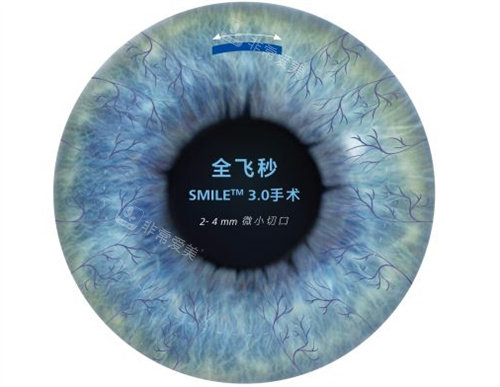 半飞秒手术卡通图