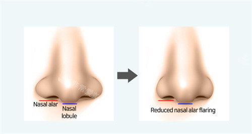 鼻翼缩小的对比图