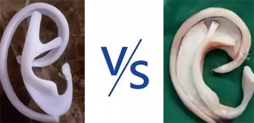 耳再造自体肋软骨和生物材料对比