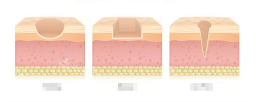 三种不同类型的疤痕