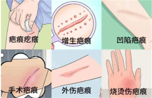 疤痕的不同类型