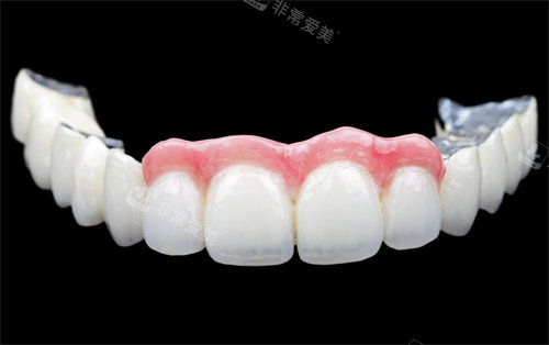 牙齿贴面展示jpg
