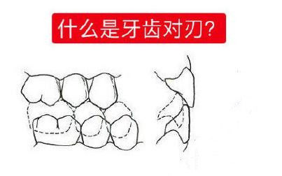 什么是牙齿对刃