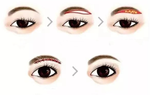 提眉手术流程示意图