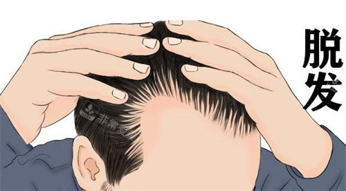 发际线后移 发际线后移