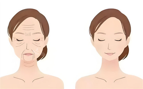 眼袋手术前后对动画图 眼袋手术前后对动画图