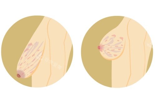 胸部下垂手术前后示意图