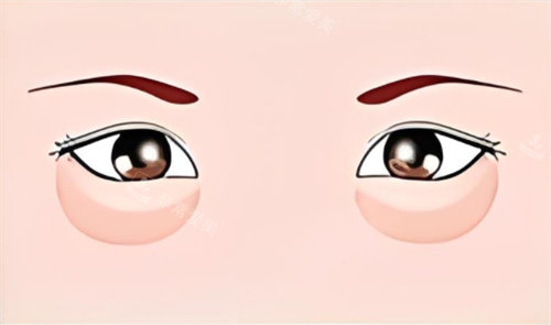 眼袋的示意图