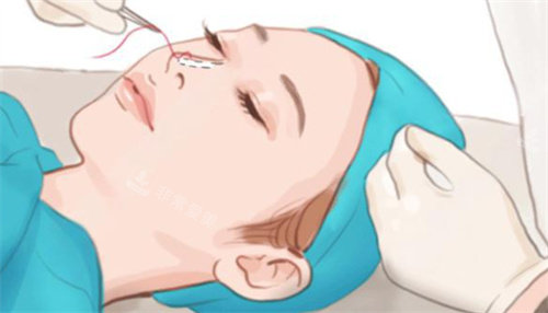 隆鼻手術(shù)示圖