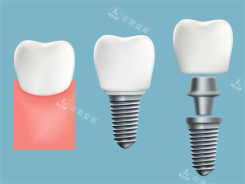 牙齿种植过程图