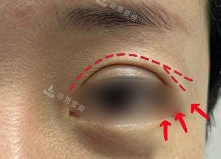 双眼皮眼尾开叉