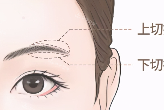 提眉上下切口示意图