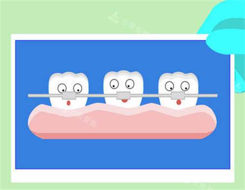 牙齿矫正卡通图展示