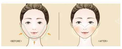 磨骨手术前后的区别 磨骨手术前后的区别