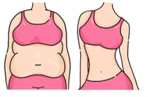 吸脂前后对比图展示