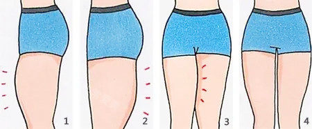 大腿吸脂卡通图