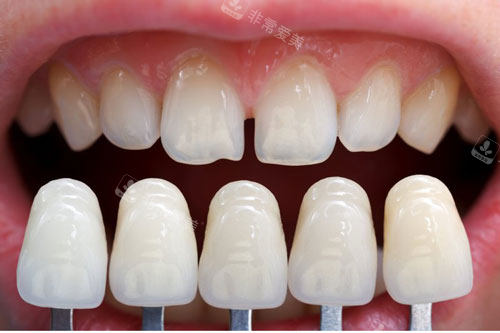 牙齿贴面颜色对比图