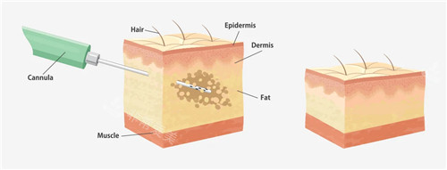 吸脂手术动画图展示 吸脂手术动画图展示