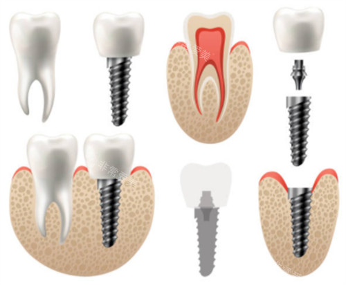 牙齿种植前后对比图