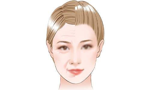 面部抗衰老的意义 面部抗衰老的意义